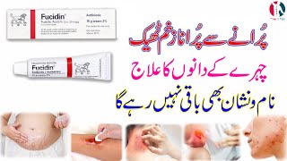 fucidin topical cream  fucidin cream  fucidin h cream uses in urdu  fucidin acid  how to use [upl. by Neomah]