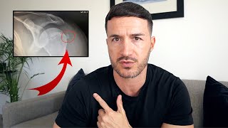 Calcific Tendonitis Shoulder Recovery my 3 year journey [upl. by Elfont]