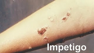 Impetigo [upl. by Bautram]