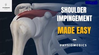 Shoulder Impingement Syndrome  Shoulder Acromion Pain  Shoulder Impingement Exercises [upl. by Hplodur]