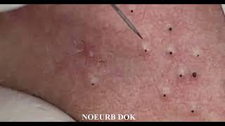 Popping Tons Of Blackheads Part 01 [upl. by Hooker427]