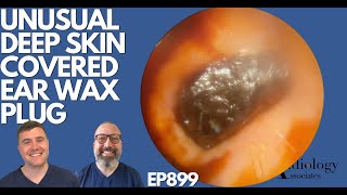 UNUSUAL DEEP SKIN COVERED EAR WAX PLUG  EP899 [upl. by Albina]