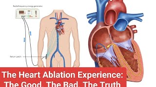 The Heart Ablation Experience The Good The Bad and The Truth electrophysiology EPStudy [upl. by Neenwahs]