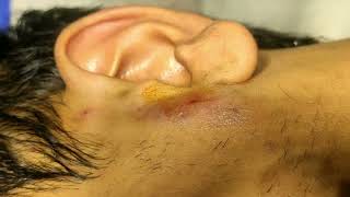 Preauricular abscess drainage without Incision No IncisionDr D K Gupta [upl. by Aliwt]