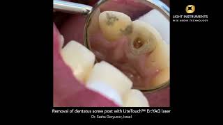 Removal of dentatus screw post with LiteTouch™ ErYAG laser [upl. by Eillam]