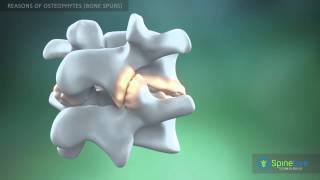 Osteophytes bone spurs Reasons [upl. by Edwards]