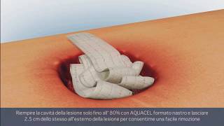 ConvaTec  AVELLE™ Sistema di terapia a pressione negativa Lesioni Profonde [upl. by Aimal]