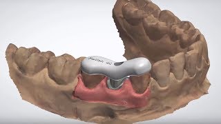 3Shape Dental System  Positioning Guide Design [upl. by Lytle]