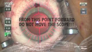 Predictability of cataract surgery refractive outcomes using intraoperative aberrometry system [upl. by Oht746]