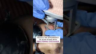 Fractional CO2 Laser Treatment at Reincarnation Skin Clinic [upl. by Shenan]