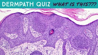 Dermpath Quiz Case  What is the diagnosis answer link in video description pathology dermatology [upl. by Mcmahon]