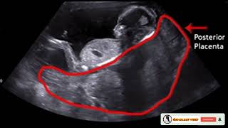 Baby Gender and placenta Positions in pregnancyPlacenta on Ultrasound [upl. by Llertnor]