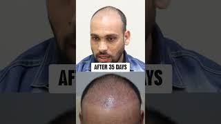 My 6 Months Hair Transplant Result  Hyderabad [upl. by Anotal771]