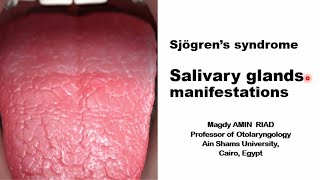 Sjögren’s syndrome Salivary glands manifestations [upl. by Sokul]