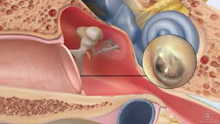 Repair a perforated ear drum using ClearDrum [upl. by Erdda]