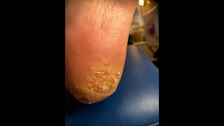 Getting rid of verrucas for good Plantar Wart Verruca Removal [upl. by Zamir]