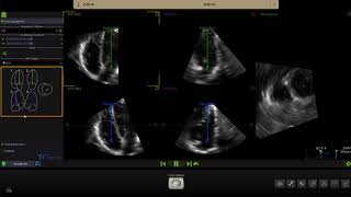 Lévaluation du ventricule droit avec le 3D Auto VD Philips [upl. by Ardnyk]