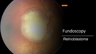 Retinoblastoma Fundoscopy [upl. by Semadar817]