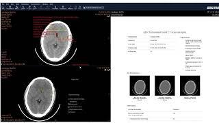 How to qER Radiology AI in Sectra PACS [upl. by Proudfoot]