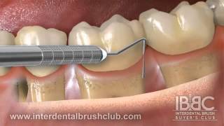 Periodontal disease causes and treatment [upl. by Balsam]