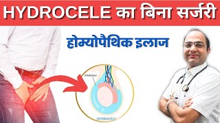 Hydrocele का बिना सर्जरी इलाज  Best Homeopathic Treatment for Hydrocele  Hydrocele Best Doctor [upl. by Annahsad]