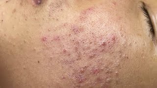 ACNE TREATMENT VU QUYNH MI Blackheads On Boy Face 2024 [upl. by Joby699]