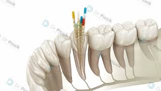 leczenie endodontyczne zęba [upl. by Tuchman]