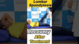 Lumbar Spondylosis Recovery After Treatment yt ytshorts ytshortsindia india kgf [upl. by Alorac]