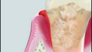 Cavitron on severe periodontitis [upl. by Htebasyle]