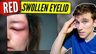 Swollen Eyelid causes amp solutions  Eye Doctor Explains [upl. by Aman]