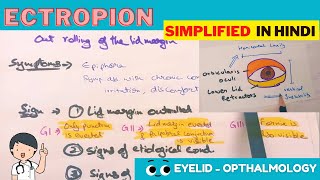 Ectropion  Hindi  Opthalmology [upl. by Hess793]