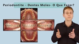 Vi que Tenho Periodontite e Dentes Moles  O Que Devo Fazer [upl. by Arelc682]