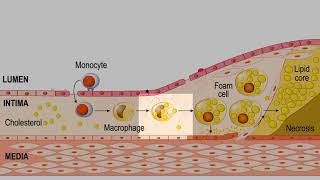 LDL CHOLESTEROL FOAM CELLS PLAQUE ATHEROSCLEROSIS EXPLAINED [upl. by Leaj]