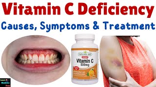 Vitamin C Deficiency – Causes Symptoms Diagnosis Treatment amp Prevention [upl. by Elissa170]