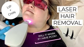 I GOT LASER HAIR REMOVAL ON MY LIP AND CHIN  PCOS  SPADERMA CHICAGO [upl. by Scott]