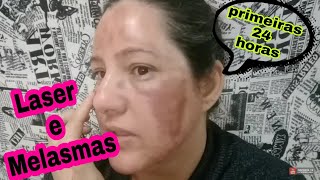 Laser fracionado As primeiras 24 horasDOEUMELASMA [upl. by Almena]