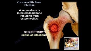 Osteomyelitis Bone Infection  Everything You Need To Know  Dr Nabil Ebraheim [upl. by Atived]