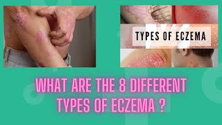 What Are the 8 Different Types of Eczema eczema [upl. by Alyel257]