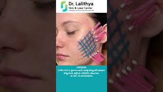 PDO Threads Treatment for Acne Scars  Dr Lalithya Kadimi  Dr Lalithya Derma Nalgonda [upl. by Bronwen]