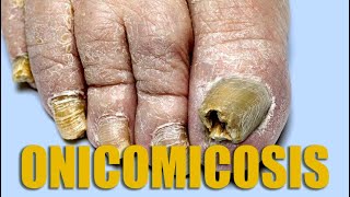 ONICOMICOSIS  Micología Paquioniquia Uñas gruesas Hongo en uñas Tiña de las Uñas  Dr Bonifaz [upl. by Aekahs]