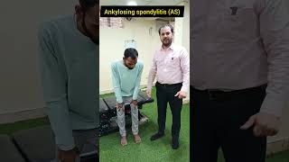 Ankylosing Spondylitis as delhi trending ankylosingspondylitis [upl. by Kaja]