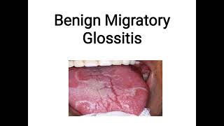 benign migratory glossitis [upl. by Dita]