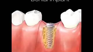 Dental Implant Procedure [upl. by Ashwell635]