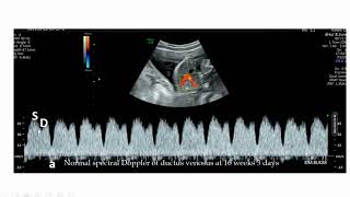 DOPPLER OF DUCTUS VENOSUS [upl. by Caesaria]