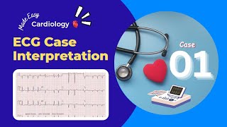 Abnormality in ECG Graph  Discussion about ECG Cases  ECG Cases for Students [upl. by Katerine300]