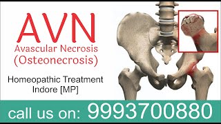 Avascular necrosis AVN osteonecrosis Homeopathic Treatment dr ak Dwivedi Anand Gujrat Vijay Patel [upl. by Jarvis]