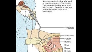 Video Cystoscopy Actual Procedure ENG SUB [upl. by Analrahc479]