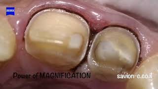 Less Invasive Veneer Preparation with Magnification Enhancing Your Smile [upl. by Tnias]