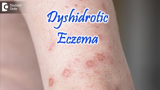 Dyshidrotic Eczema  POMPHOLYX   Causes Symptoms amp Treatment  Dr Nischal K  Doctors Circle [upl. by Haikan]