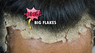 Picking BIG Scalp Flakes Psoriasis Satisfying 745 [upl. by Eirrej]